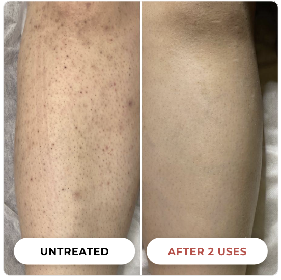 Before and after — visible KP smoothing, untreated vs after 2 uses