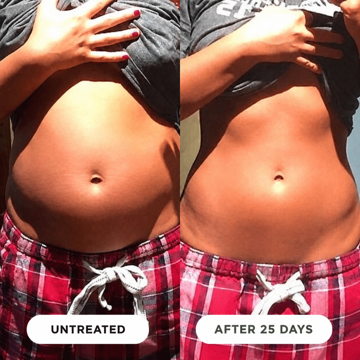 Before and after — untreated vs. after 25 days, less bloating